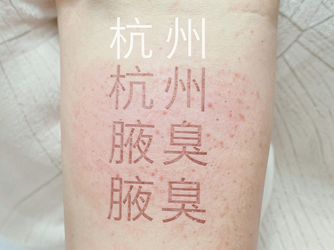 杭州腋臭医院哪家好?治狐臭别踩坑,杭州腋秀腋臭专科教你看懂腋臭治疗 杭州腋臭医院哪家好?治狐臭别踩坑,杭州腋秀腋臭专科教你看懂腋臭治疗